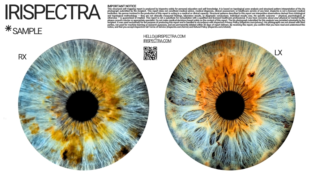 irispectra sample report showing bilateral iris analysis